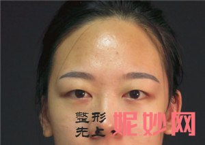 来看看北京正美医疗美容诊所的郑永生医生的切开双眼皮真人案例分享！