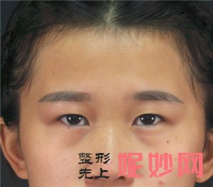 到北京正美找郑永生医生做眼部多项，术后三个月眼睛恢复很自然