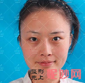 北京美莱医疗美容医院谭章梅做眼综合整形的案例