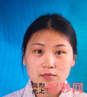 到北京美莱医疗美容找叶宇做眼部多项怎么样？术后50真人案例分享