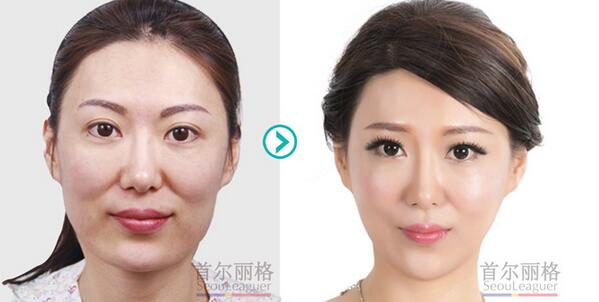 改脸型手术价格，上海首尔丽格V-line改脸型