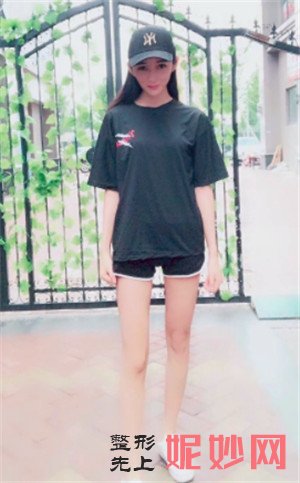 到北京蕊丽找赵英利做的吸脂瘦大腿怎么样？术后案例效果对比图分享！