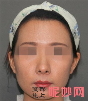 在北京圣嘉新医疗美容医院找张笑天做面部吸脂怎么样？真人案例分享