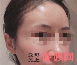 北京圣嘉新的张笑天医生做面部吸脂的技术怎么样？真人案例对比图展示