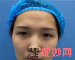 到北京壹加壹找张晓亮医生做切开双眼皮，术后52天眼睛恢复得非常好