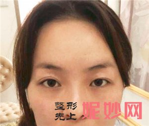在北京华悦府找张鹏医生做的眼部多项手术，术后70天眼睛有神多了