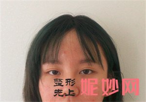 在北京华悦府找张鹏医生做的切开双眼皮，术后80天真人案例分享
