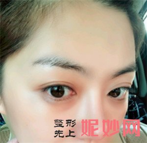 在北京新面孔医疗美容诊所找赵海成做的鼻部多项，术后鼻子精致又可爱
