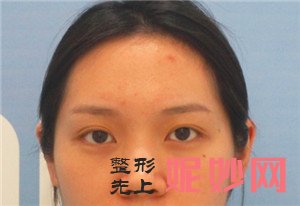 北京新面孔的赵海成做肋软骨隆鼻技术怎么样？真人案例分享