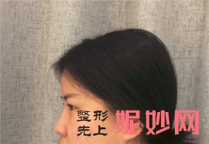 在北京新面孔医疗美容诊所找赵海成做肋软骨隆鼻，真人案例对比图展示