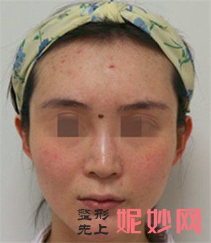 一起来看看在北京圣嘉新找张笑天医生做的面部吸脂真人案例分享！