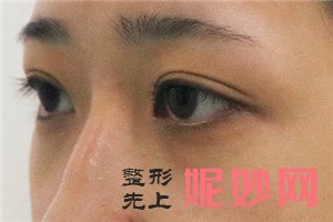 到北京华悦府找张鹏做的眼部多项手术效果怎么样？真人案例分享