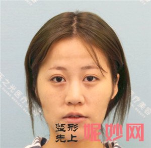 到北京玉之光整形找张红芳做自体脂肪面部填充，术后68天真人案例展示