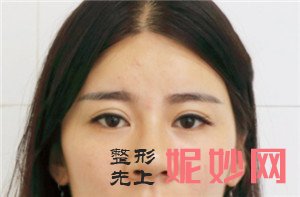 到北京金燕子医疗美容诊所找张巩佳做鼻部多项，术后70天鼻子高挺很多