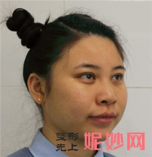 北京金燕子的张巩佳做面部吸脂的技术怎么样？真人案例效果图分享