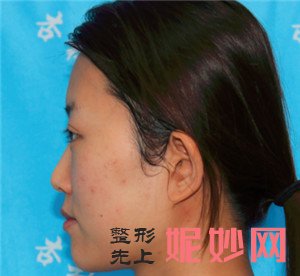 到北京杏林美找于红敏做自体脂肪面部填充，术后100天恢复效果非常好
