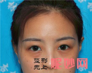 北京杏林美医疗美容诊所的于红敏做埋线双眼皮怎么样？真人案例分享