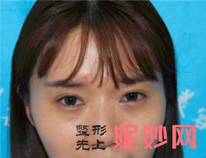 在北京杏林美医疗美容诊所找于红敏做的硅胶隆鼻，术后120天鼻子很自然