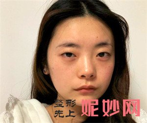 北京炫美的岳莉棡医生做双眼皮技术怎么样？真人案例效果图展示