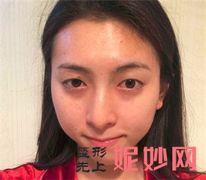 到北京炫美医疗美容诊所找岳莉棡做的埋线双眼皮，术后双眼皮恢复很自然