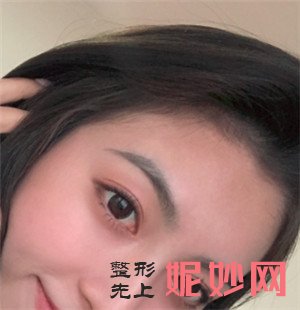 到北京炫美医疗美容诊所找岳莉棡做的埋线双眼皮，术后双眼皮恢复很自然