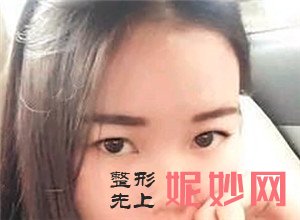 在北京炫美找岳莉棡做的鼻部多项怎么样？真人案例对比图分享