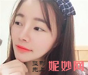 在北京炫美找岳莉棡做的鼻部多项怎么样？真人案例对比图分享