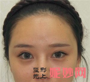在北京东环亦美找余若晖做的面部吸脂怎么样？术后108天拥有小V脸
