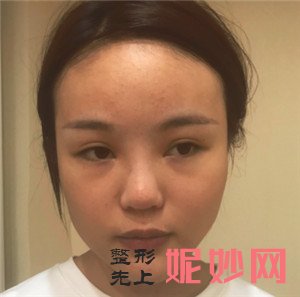 来看看北京东环亦美的余若晖医生做面部吸脂的真人案例分享！