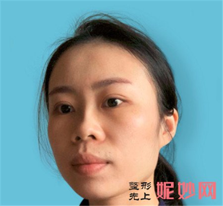 在北京科彦找易曦医生做硅胶隆鼻，术后90天鼻子恢复得非常精致