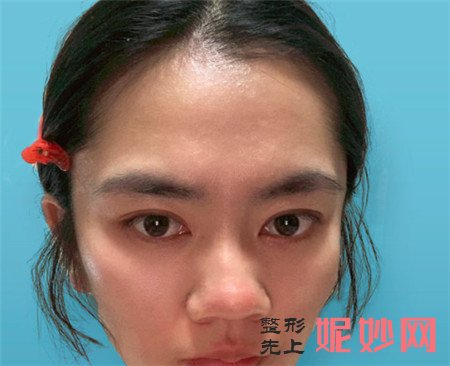 在北京科彦医疗美容诊所找易曦做的鼻部多项怎么样？术后案例对比图展示