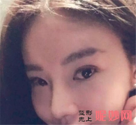 来看看在北京科彦医疗美容诊所找易曦做的鼻部多项术后130天真人案例分享！