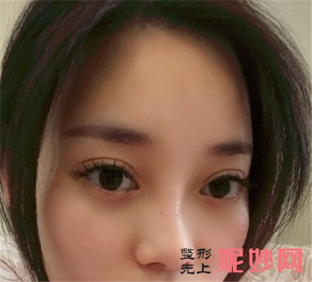 到北京画美医院找徐学东做鼻部多项，术后100天鼻子精致又可爱