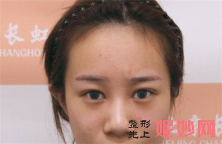 在北京画美医院找徐学东做的肋软骨隆鼻，真人案例效果图展示