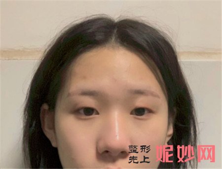 北京华韩医疗美容医院的谢立宁做眼部多项怎么样？真人案例分享