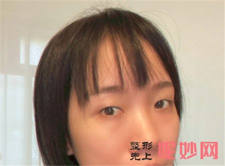 在北京华韩找谢立宁做的眼部多项，术后90天双眼皮很好看