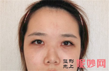 北京米扬丽格的夏正义做鼻部多项怎么样？真人案例效果图展示