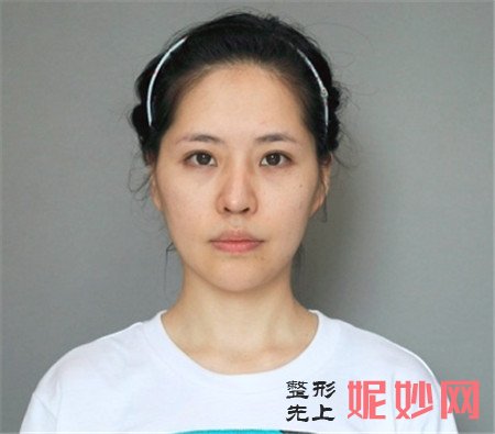 北京米扬丽格医疗美容医院的夏正义做鼻部多项怎么样？真人案例分享