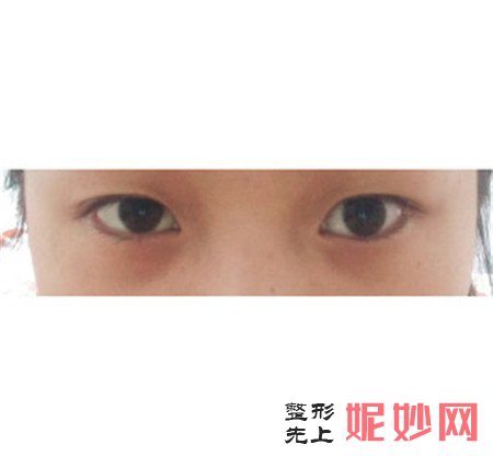 到北京大学人民医院整形外科找杨锴做的埋线双眼皮怎么样？案例效果图展示