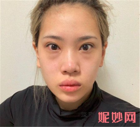 北京南加医疗美容门诊部的闫立新做假体隆鼻的技术怎么样？术后真人案例分享