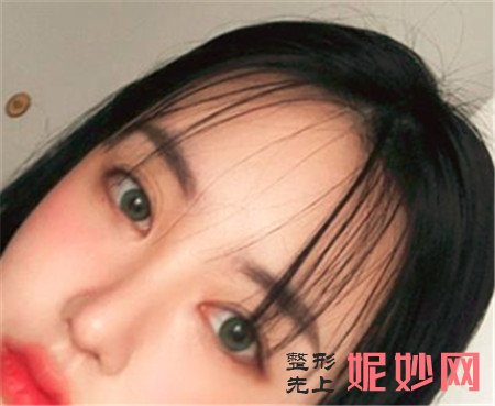 北京南加医疗美容门诊部的闫立新做假体隆鼻的技术怎么样？术后真人案例分享