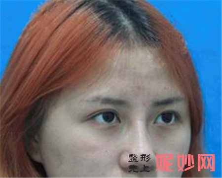 在北京南加找闫立新做的硅胶隆鼻，术后120天鼻子精致又小巧