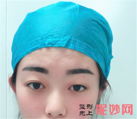 到北京英煌找王勋医生做切开双眼皮，术后90天眼睛大了不止一倍