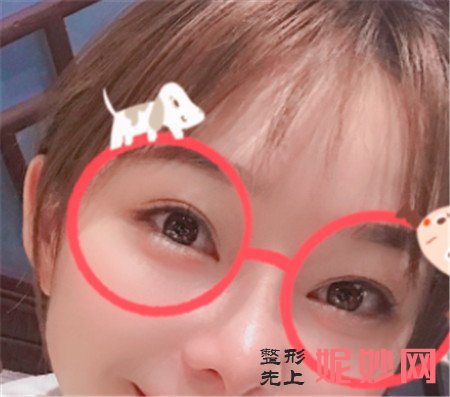 来看看北京煤医医疗美容医院的王英勇做肋软骨隆鼻的真人案例分享