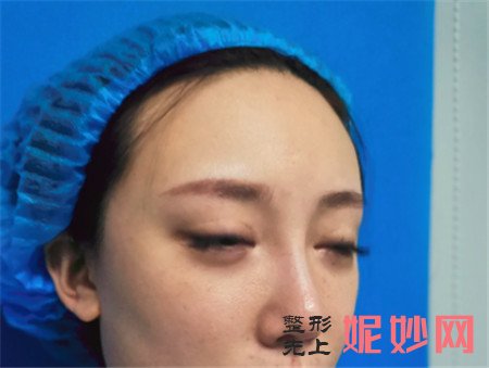 北京蜜邦医疗美容诊所的夏毓琴做面部吸脂怎么样？真人案例分享