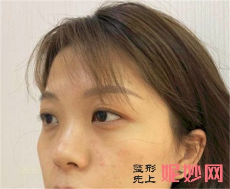 到北京蜜邦医疗美容诊所找夏毓琴做眼部多项怎么样？真人案例效果图展示