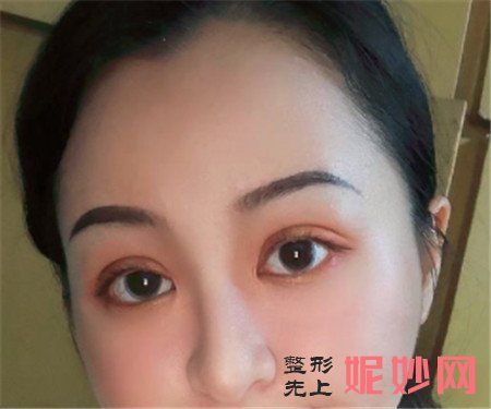 在北京蜜邦找夏毓琴医生做的眼部多项，术后108天眼睛更大更有神了
