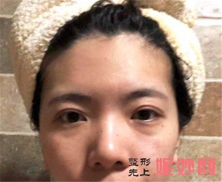 来看看在北京蜜邦医疗美容诊所找夏毓琴做的眼部多项真人案例恢复效果！