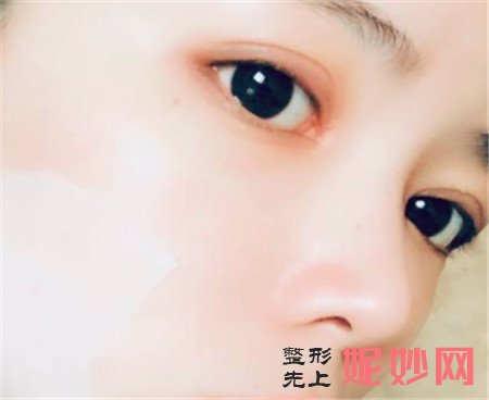 来看看在北京蜜邦医疗美容诊所找夏毓琴做的眼部多项真人案例恢复效果！
