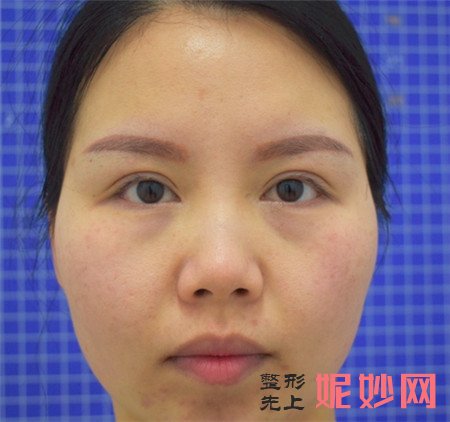来看看北京丰科星范医疗美容门诊部的王咏民做除皱瘦脸的成功案例分享！